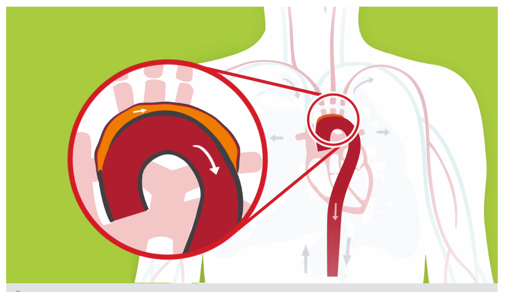 Aortic dissection image