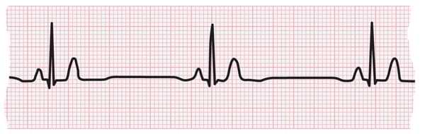 Tira de ECG que muestra bradicardia