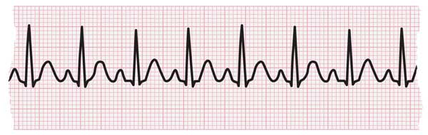 Tira de ECG que muestra taquicardia