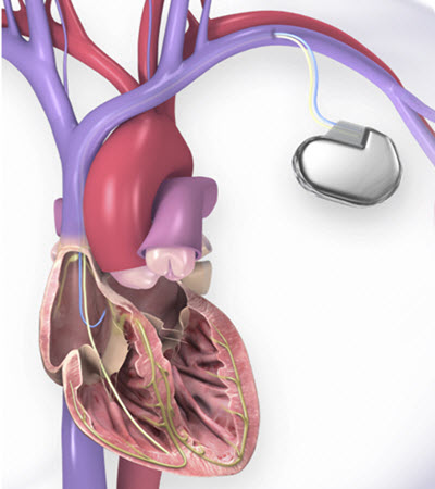 ilustración del corazón y del DCI