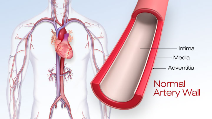 Illustration of atherosclerosis