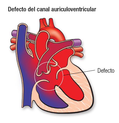 Defecto del canal AV Español