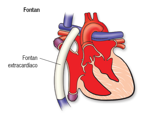 HLHS Fontan SP