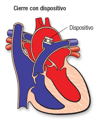 PDA Device SP