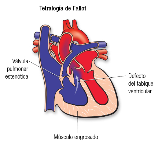 Tetralogía SP