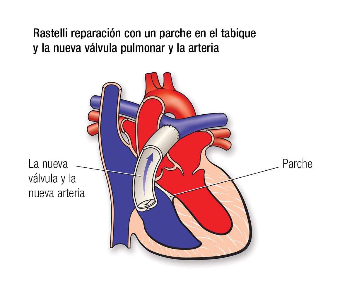 Reparación de Rastelli en español