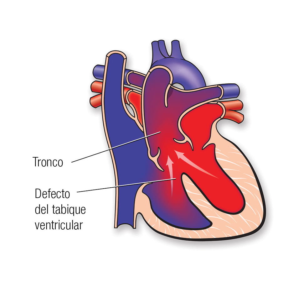 Tronco arterioso en español