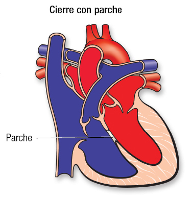 Parche en DTV Español