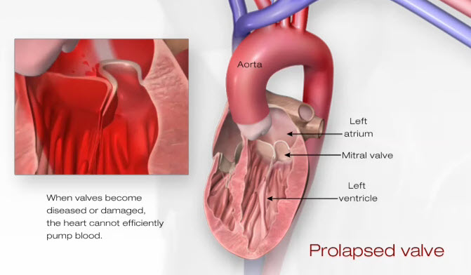 ilustración de una válvula prolapsada