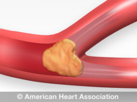 ischemic stroke