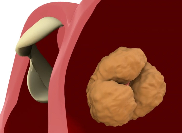 What is aortic stenosis video