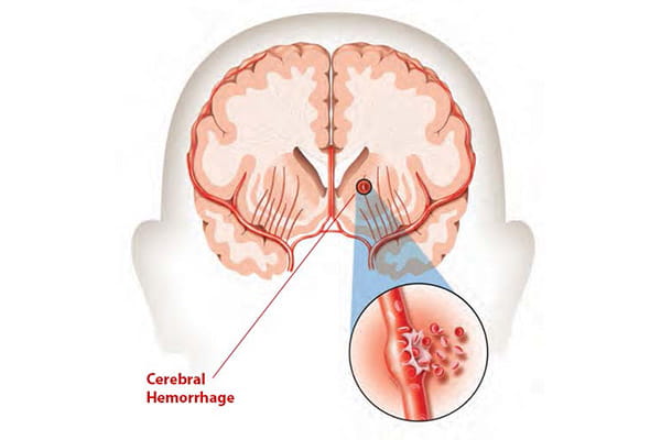 medical illustration of a cerebral hemorrhage medical illustration of a cerebral hemorrhage