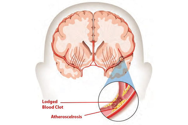 medical illustration of an ischemic stroke condition in the brain medical illustration of an ischemic stroke condition in the brain